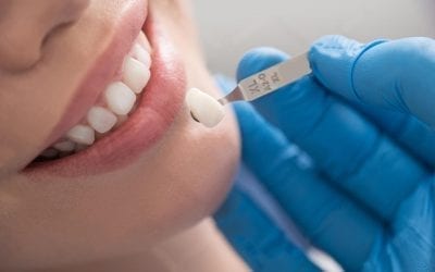 Comprehensive Guide to Dental Veneers in Singapore (2021)