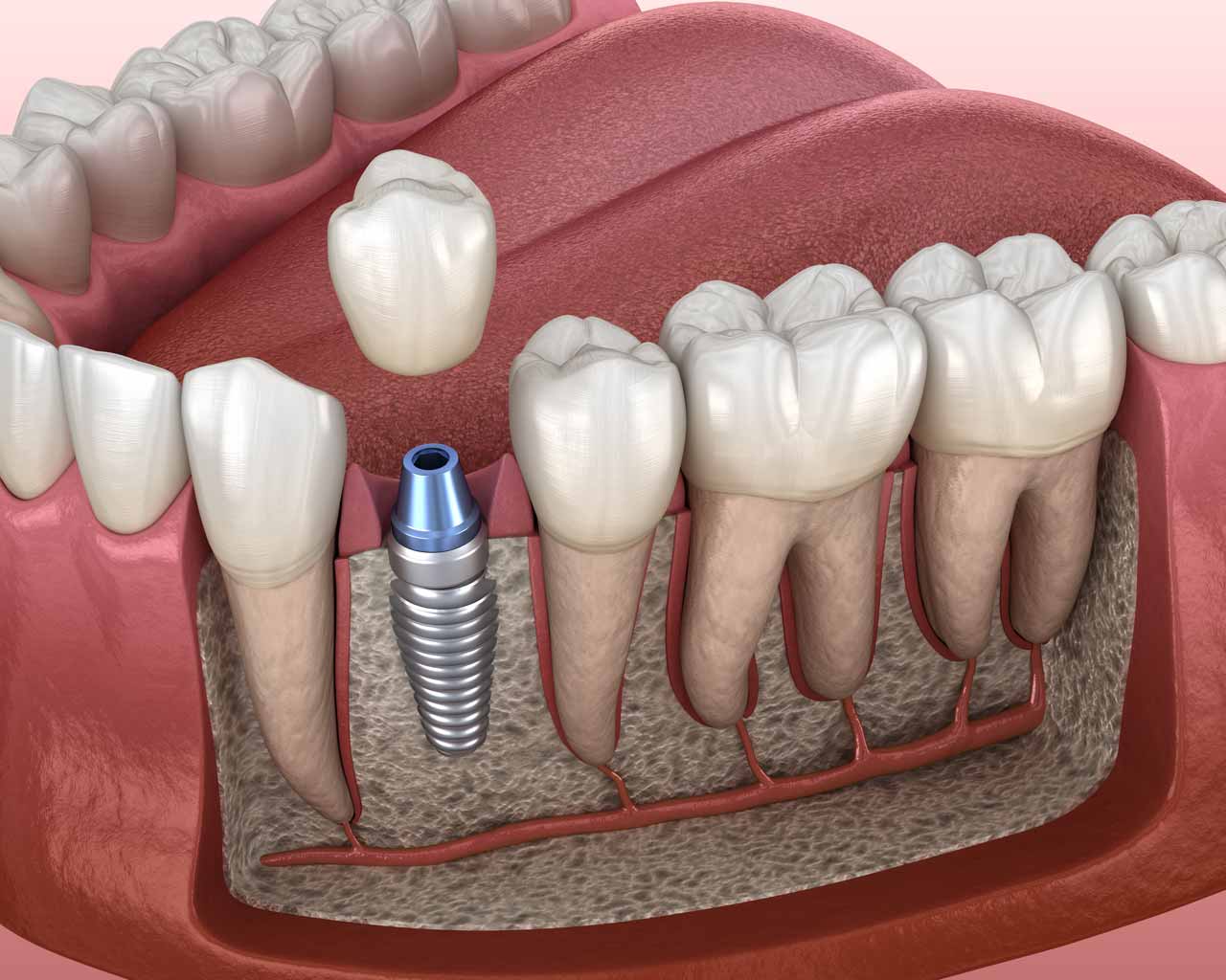 Single Dental Implant Crown