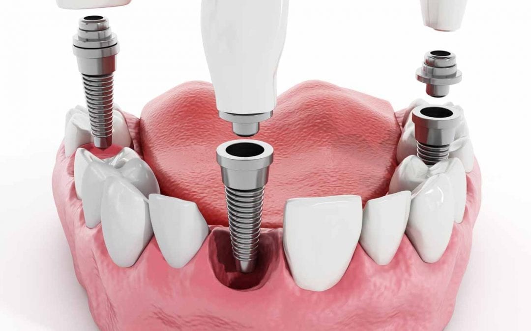 Single Dental Implant