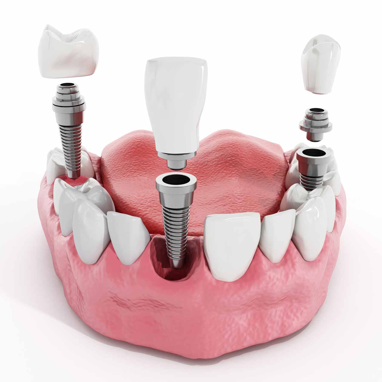 dental implants (2) Single Dental Implant