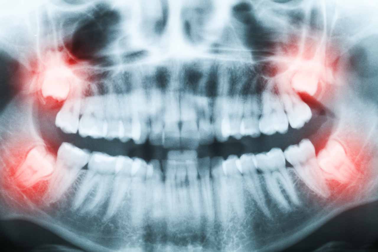 X-ray of a impacted wisdom tooth