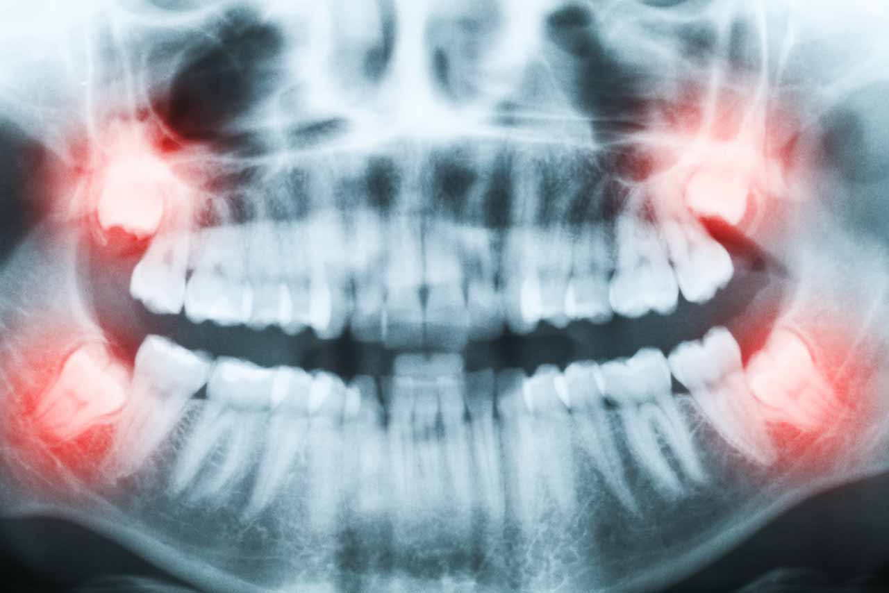 wisdom teeth (2) X-ray of a impacted wisdom tooth