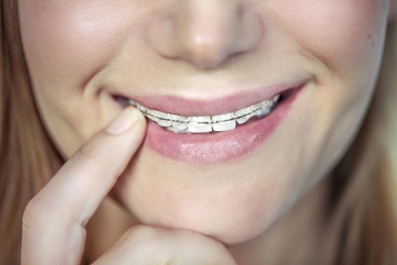 Ceramic braces in Singapore | Ceramic braces treatment in Singapore