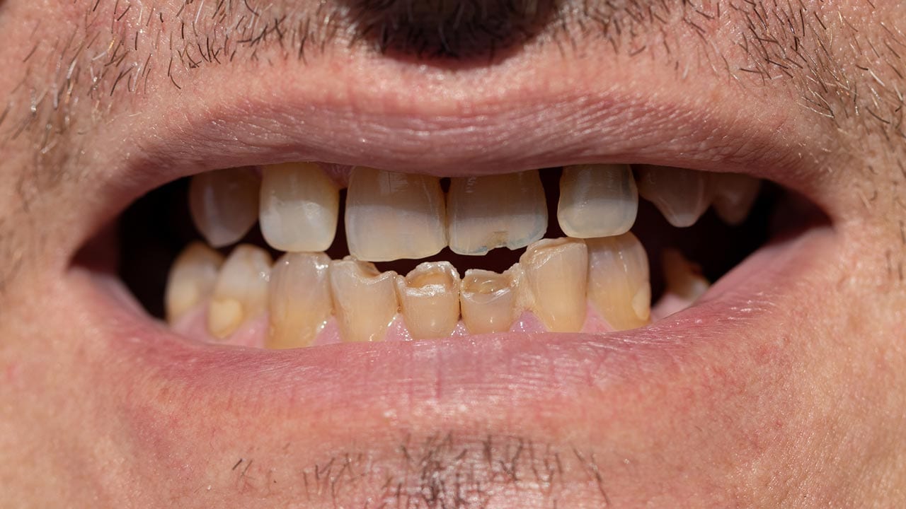 discoloured teeth due to old age