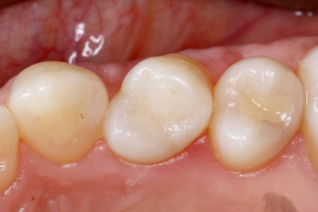 Tooth coloured composite dental resin in Singapore