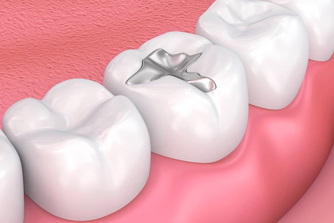 Silver Amalgam Dental Filling in Singapore