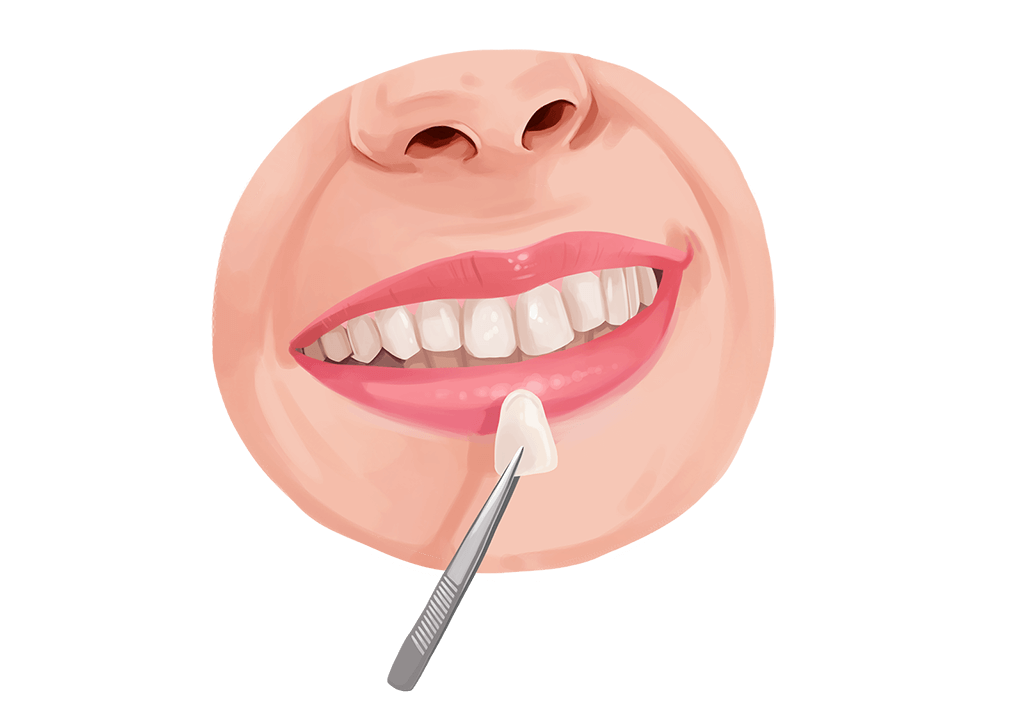 dental veneers placement on tooth cartoon