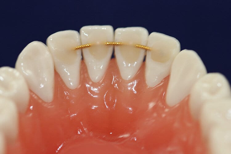 Fixed retainers fixed retainers