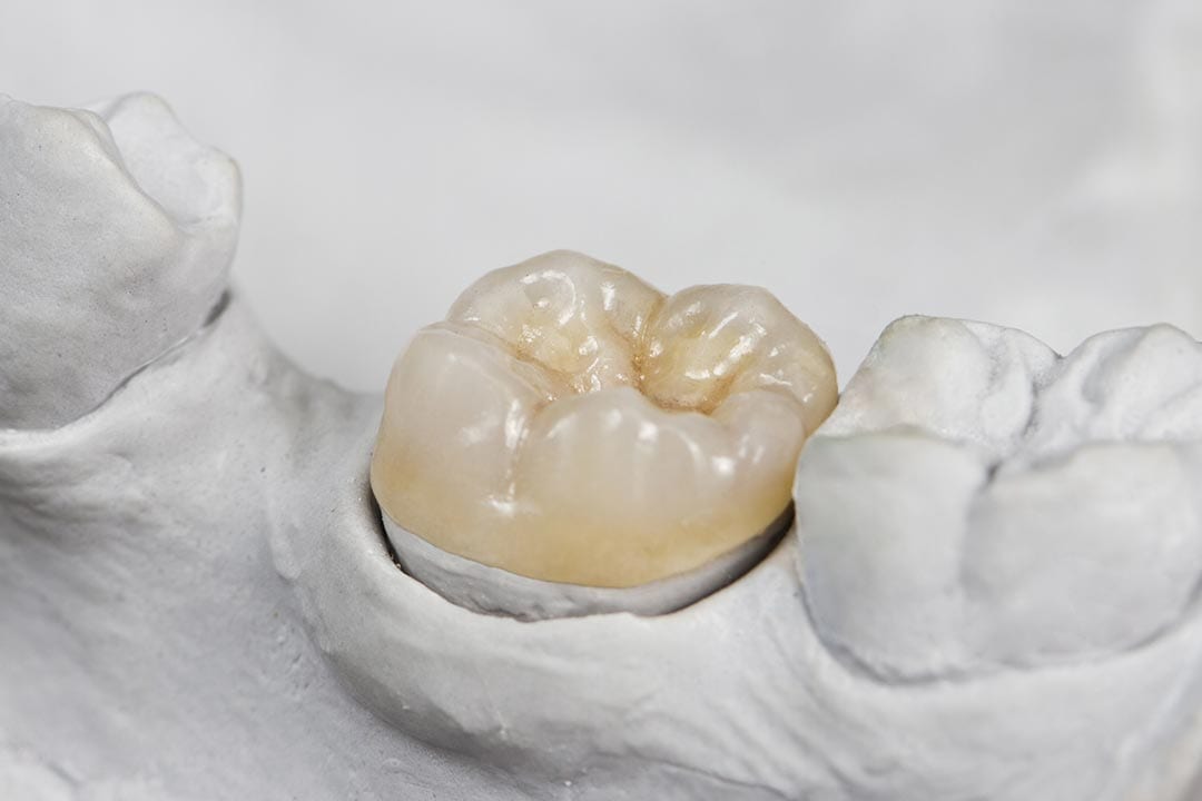 Indirect Dental Fillings Restorations - Onlys