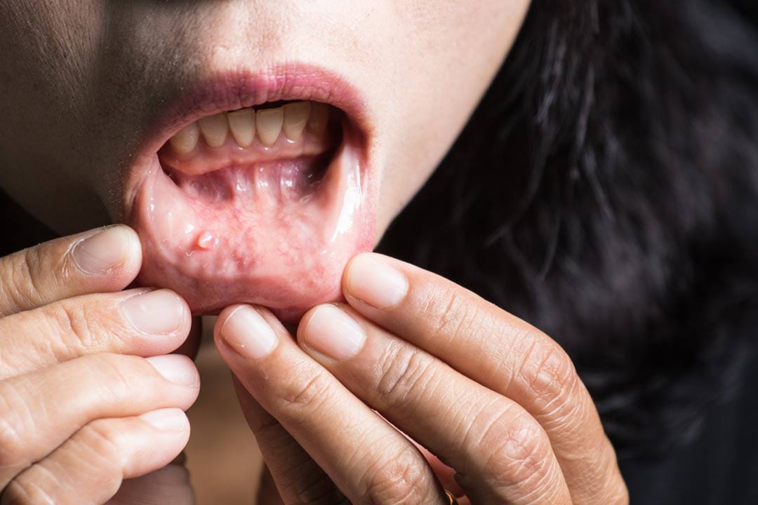 Picture of mouth cancer