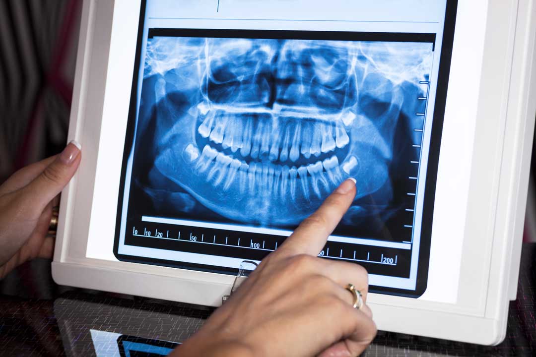 diagnosing an impacted wisdom tooth in Singapore