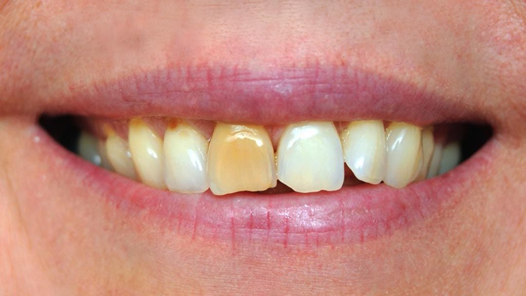 Dental veneers concealing multiple dental issues