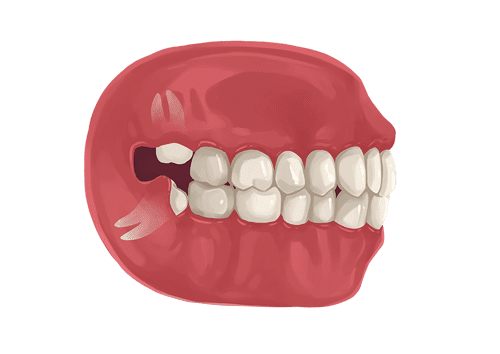 Wisdom Tooth Soft tissue - Graphic of an impacted wisdom tooth 