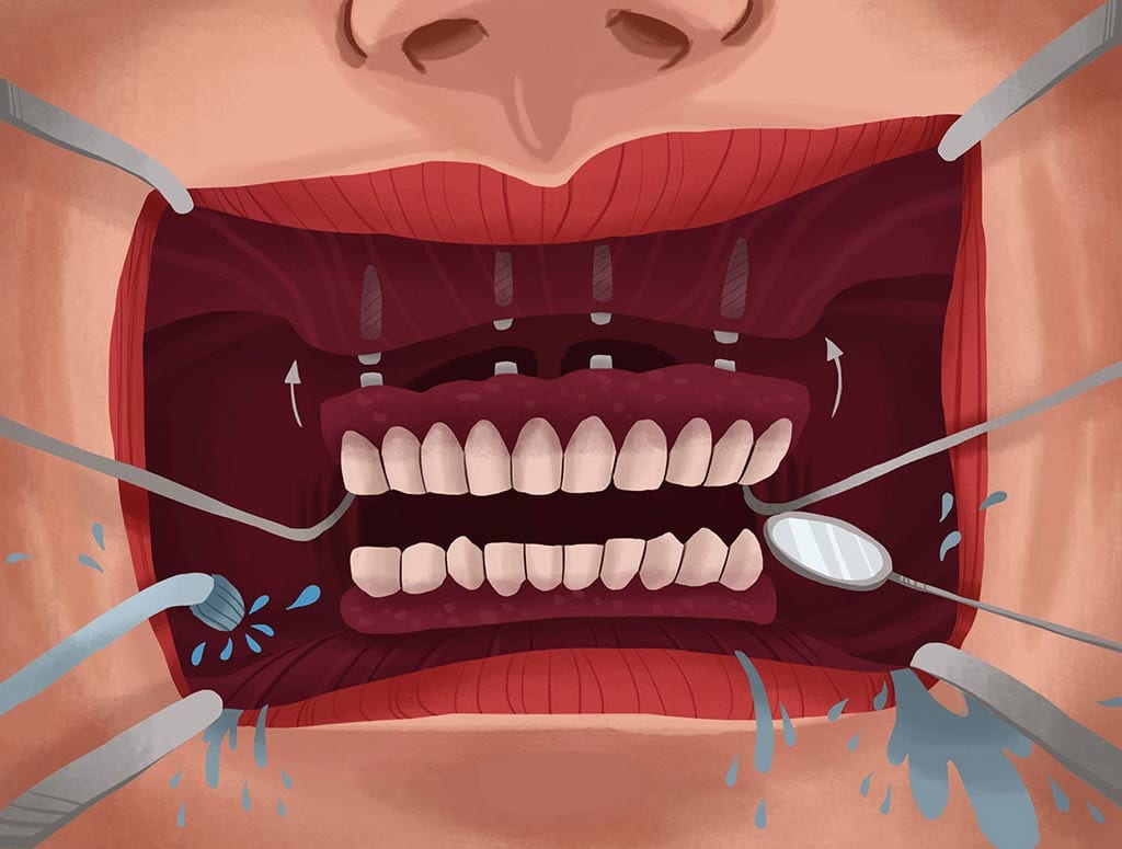 all on 4 dental implants