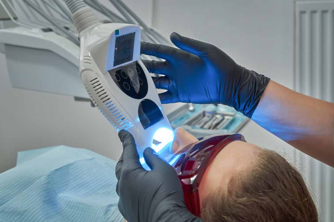 chairside-teeth-whitening chairside teeth whitening in Singapore