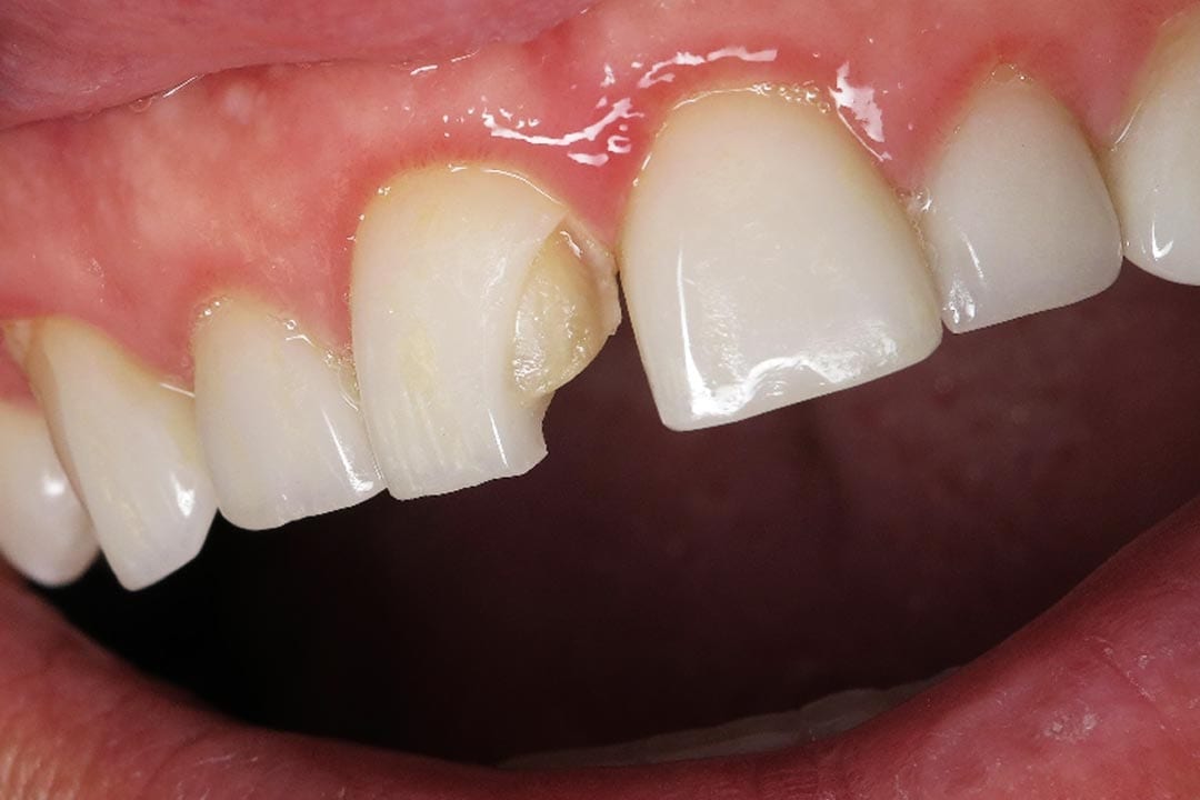 damaged dental veneer