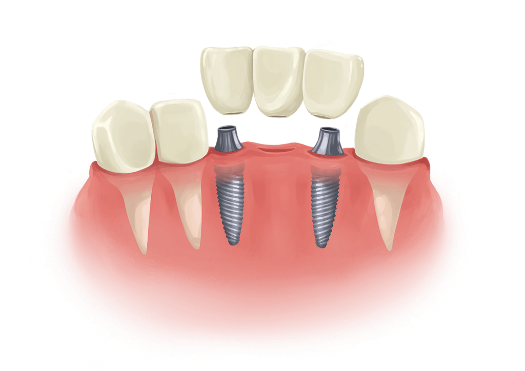 dental implant bridge cartoon