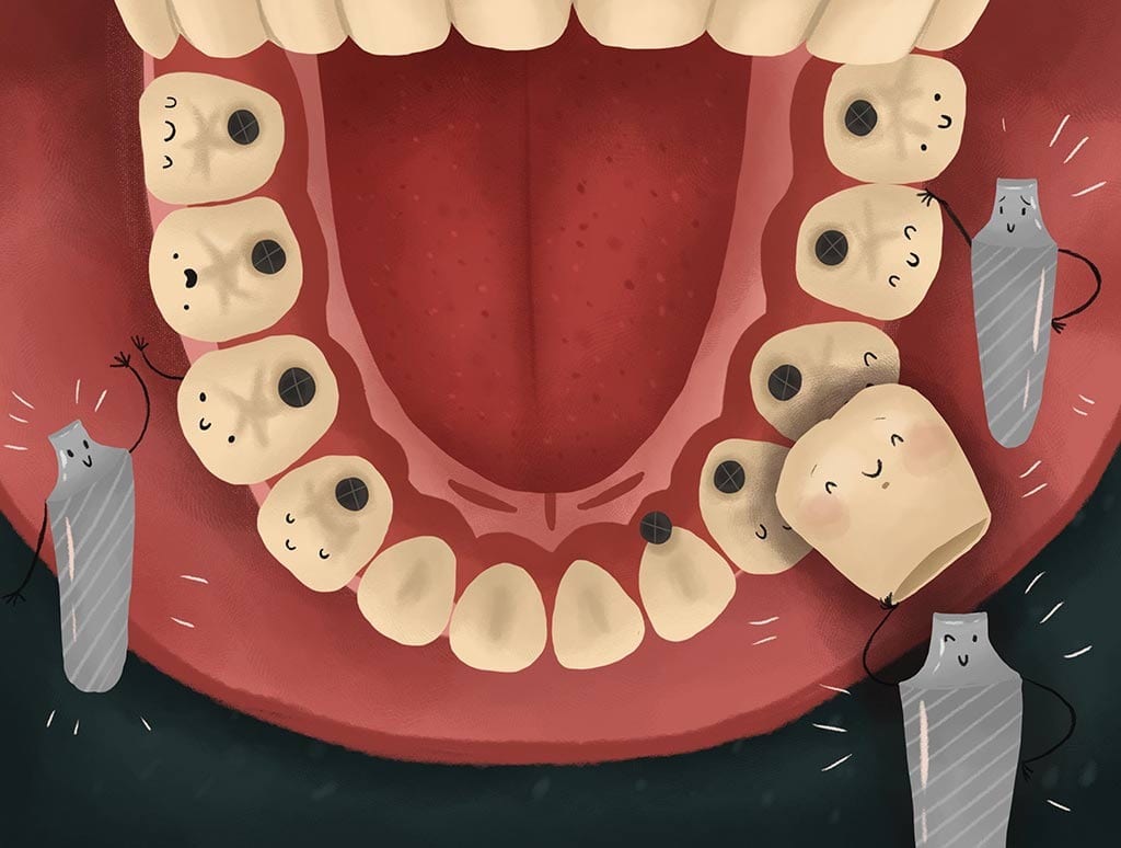 dental-implant-in-mouth-view-graphic Dental Implant in mouth view graphic