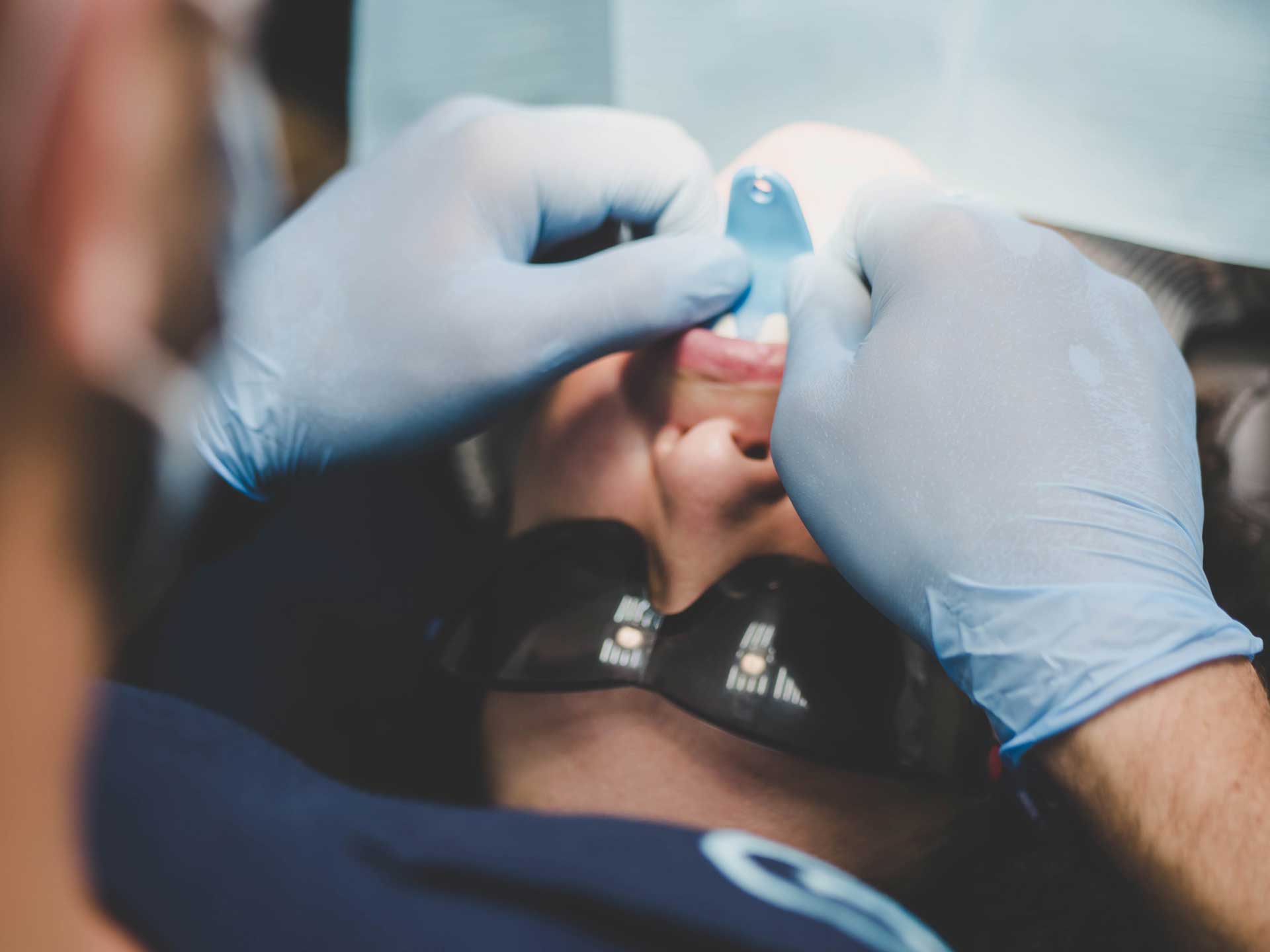 Dental veneers concealing multiple dental issues