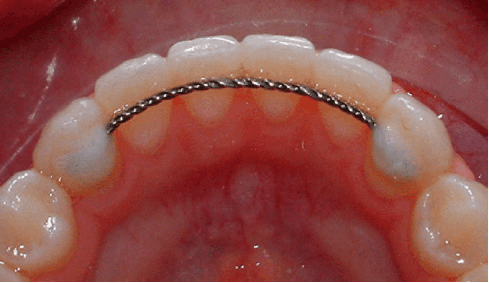 fixed-permanent retainers fixed permanent retainers in Singapore