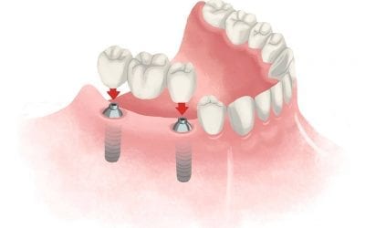 5 Commonly Asked Questions About Dental Implants