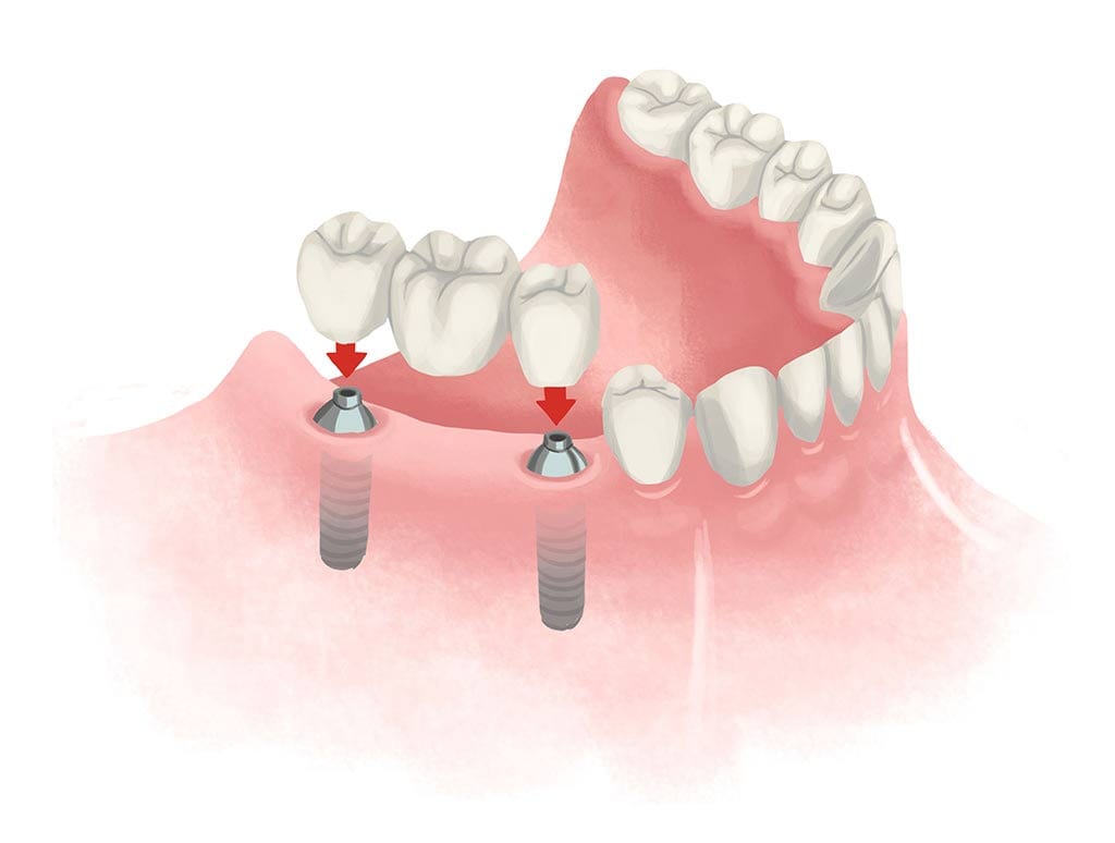 dental implant bridge cartoon