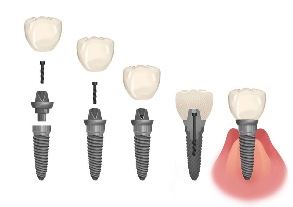 dental implant crown graphic
