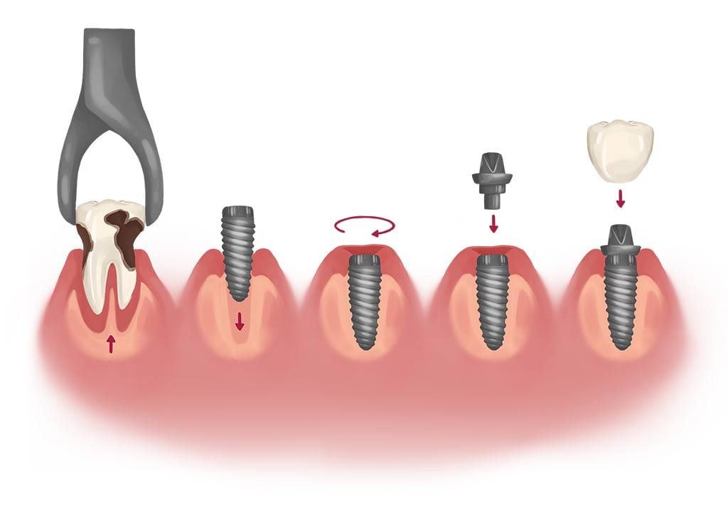 dental implant installation process