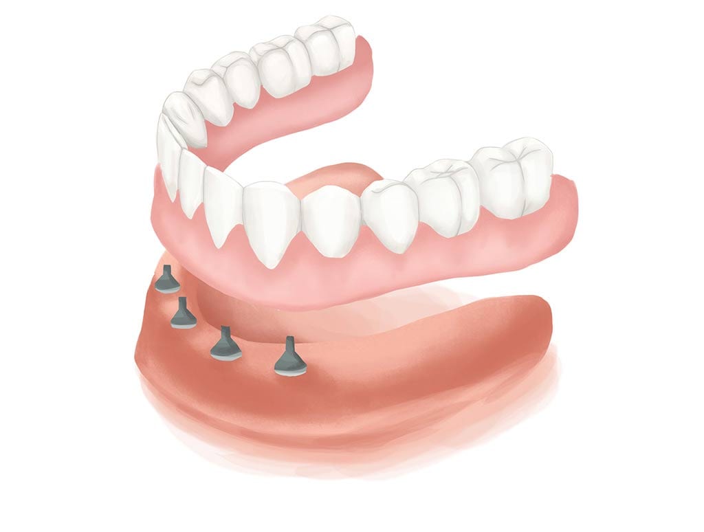 implant retained denture