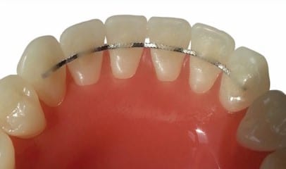 lingual permanent retainers permanent lingual retainers