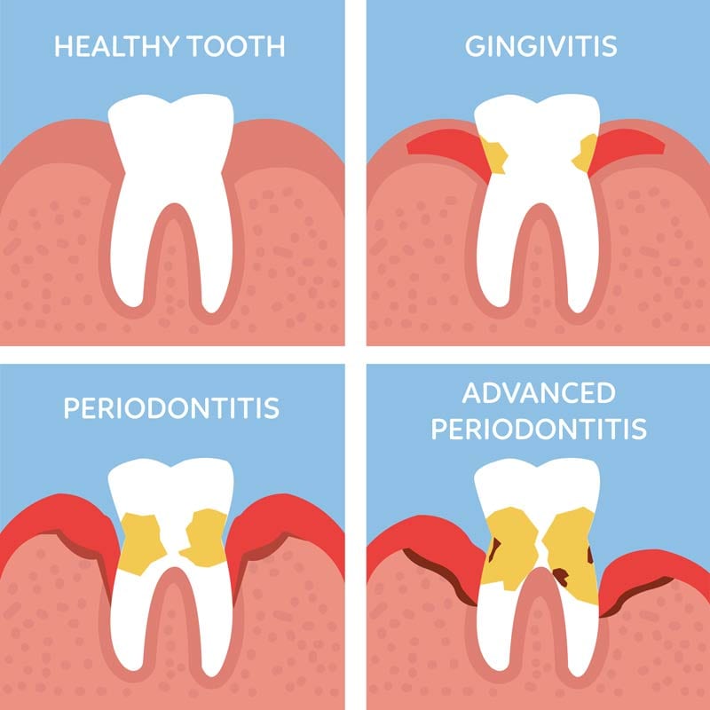 periodontal disease infographic