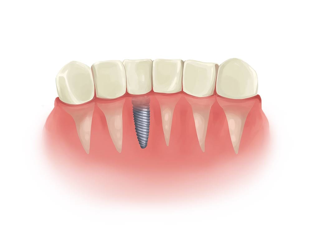 single-implant-among-teeth single dental implant among teeth cartoon