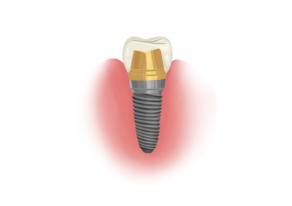 Single dental implant abutment graphic
