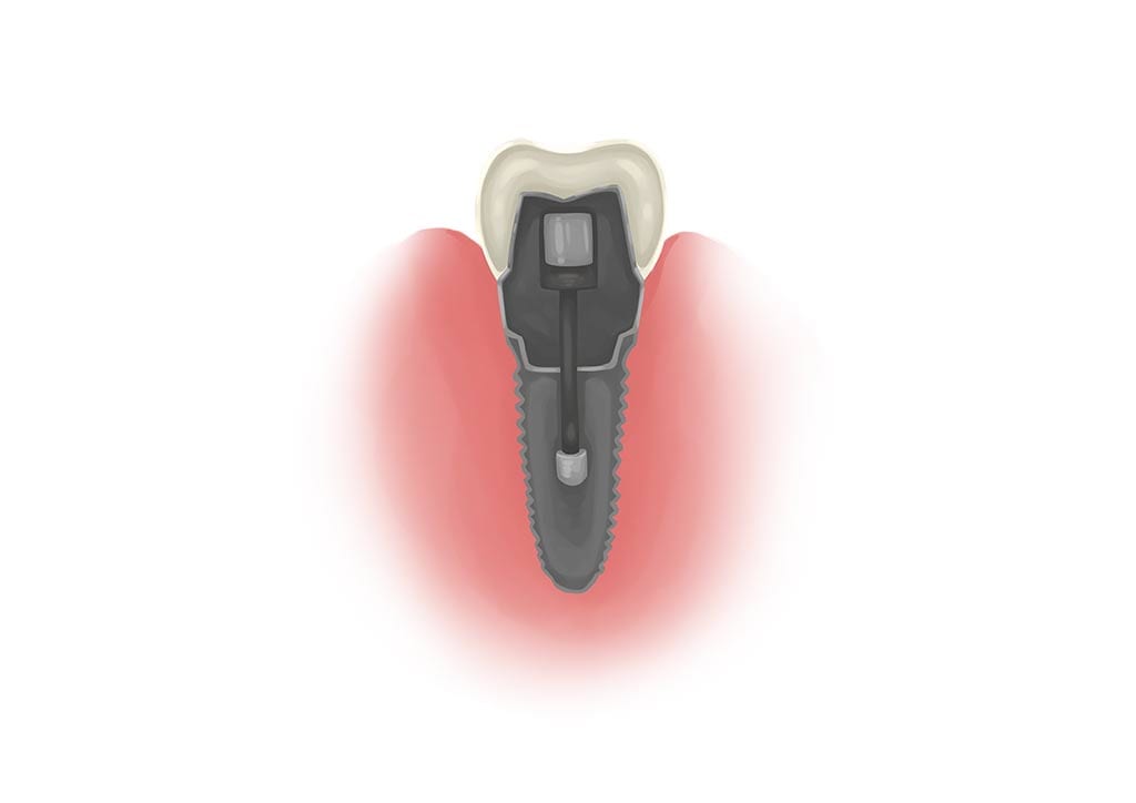 cross section of a single dental implant