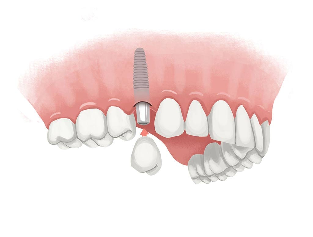 Single Dental Implant