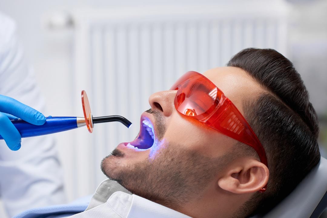 Young man getting veneers placed onto his teeth using a light cure