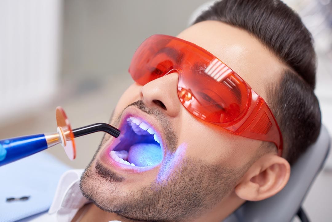Young man getting veneers placed onto his teeth using a light cure