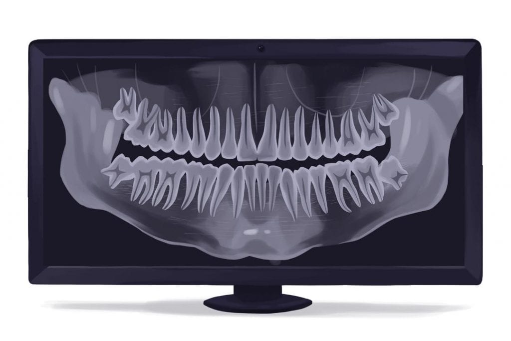 OPG xray for sinus lifts