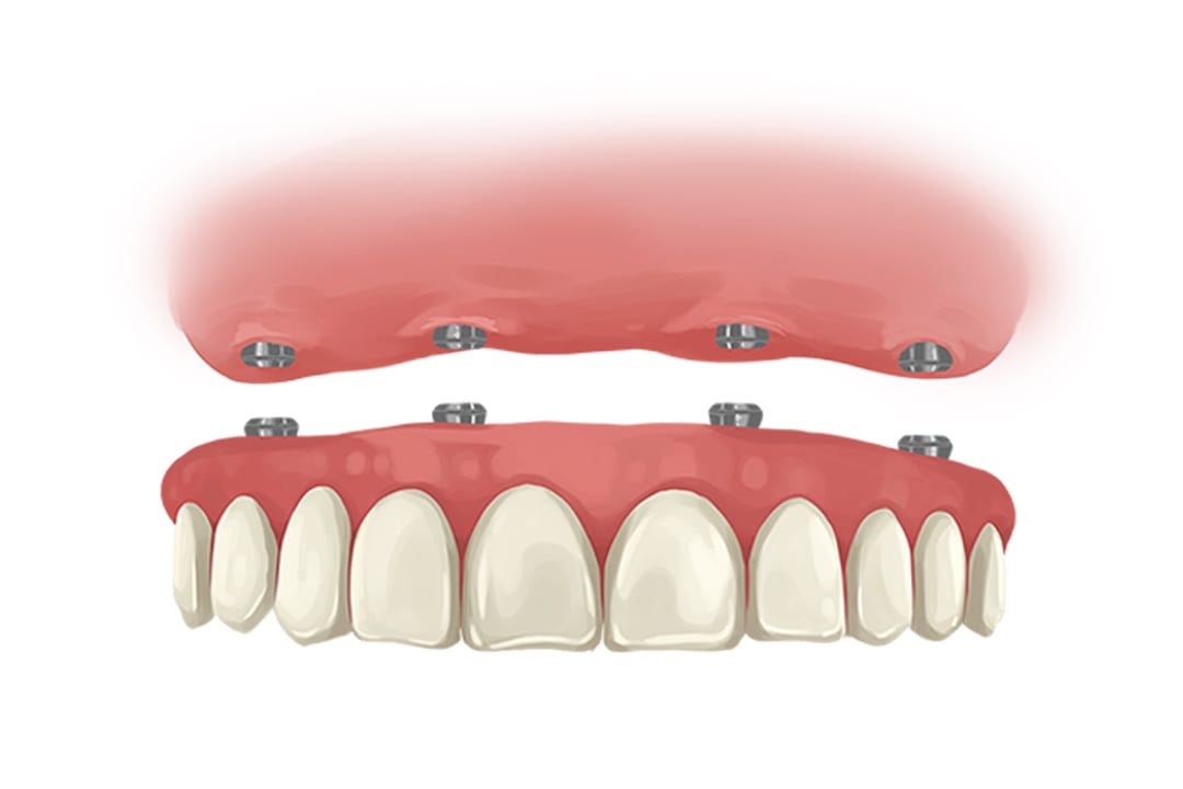 all on 4 dental implants