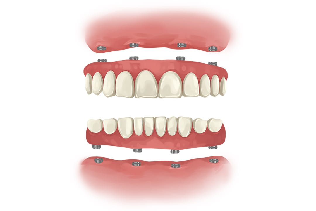 all on 4 dental implant 2 arches