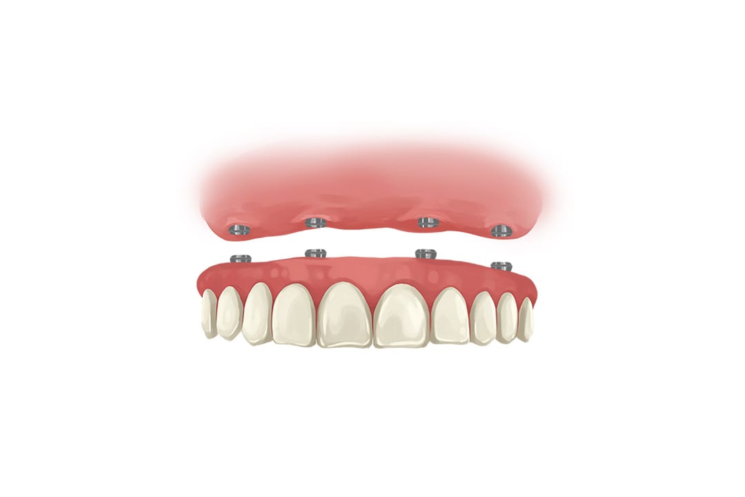 all on 4 dental implants