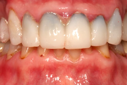 black margins due to dental veneers