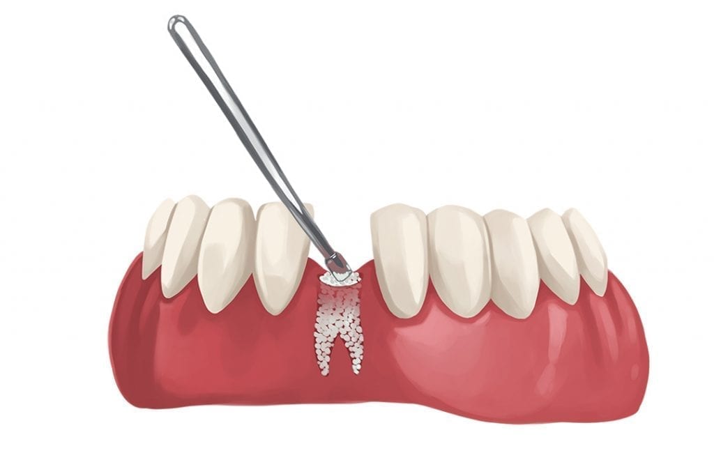 dental bone grafting required before dental implant placement due to bone loss in the jaw