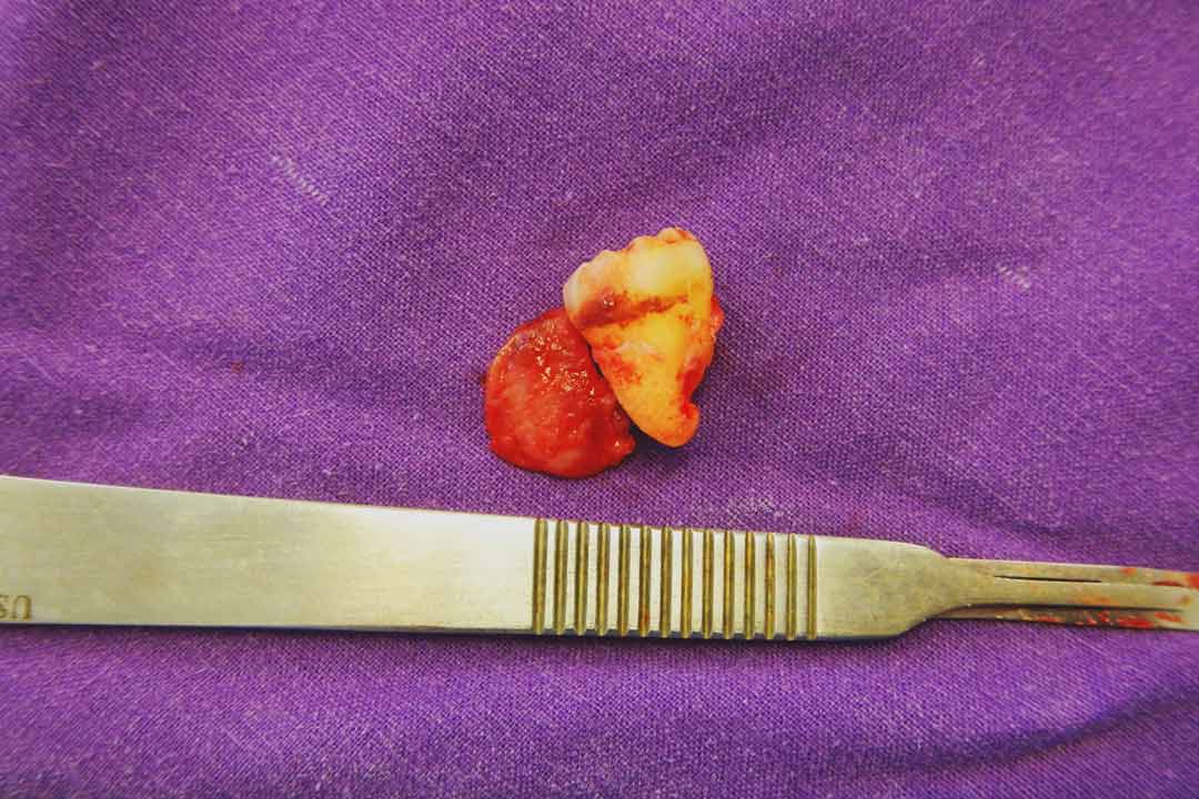 cyst-due-to-impacted-wisdom-tooth Formation of oral cysts due to impacted wisdom tooth