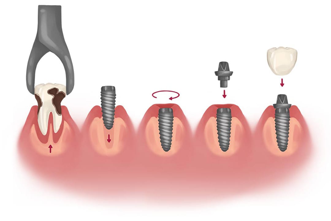 dental implant placement process