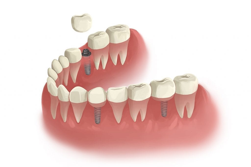 dental implant prosthesis placement
