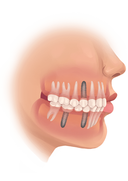 recovery after all on 4 dental implant surgery recovery after all on 4 dental implant surgery