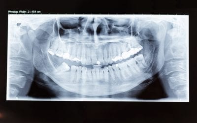 Getting the facts straight on invisible aligners: Yay or nay to X-rays?