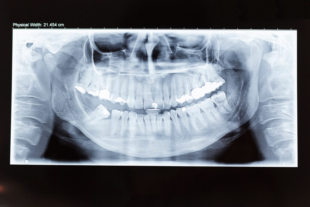 dental xray of teeth