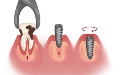 Understanding Immediate Dental Implants